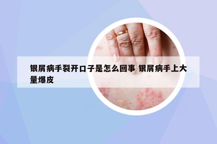 銀屑病手裂開口子是怎么回事 銀屑病手上大量爆皮