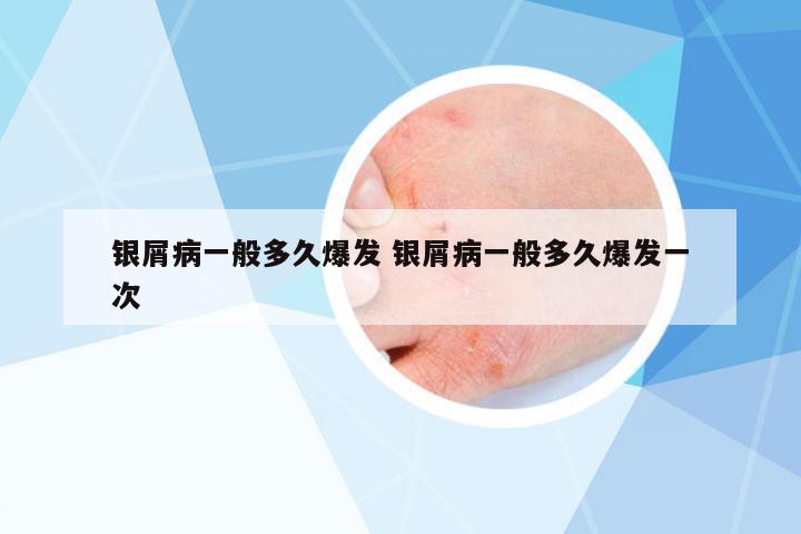 銀屑病一般多久爆發(fā) 銀屑病一般多久爆發(fā)一次