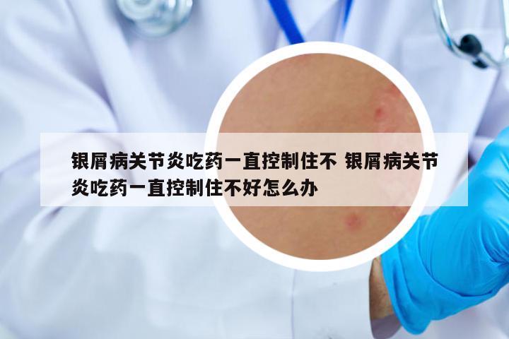 銀屑病關(guān)節(jié)炎吃藥一直控制住不 銀屑病關(guān)節(jié)炎吃藥一直控制住不好怎么辦