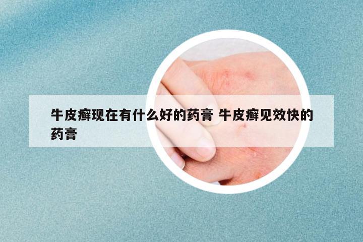 牛皮癬現(xiàn)在有什么好的藥膏 牛皮癬見效快的藥膏