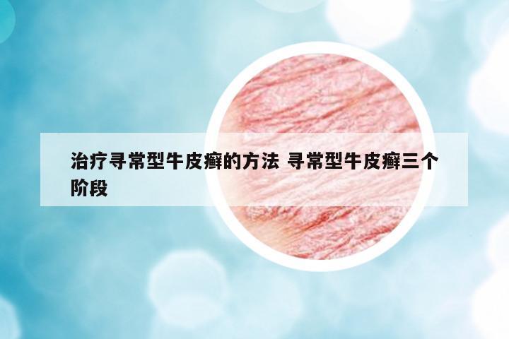 治療尋常型牛皮癬的方法 尋常型牛皮癬三個(gè)階段