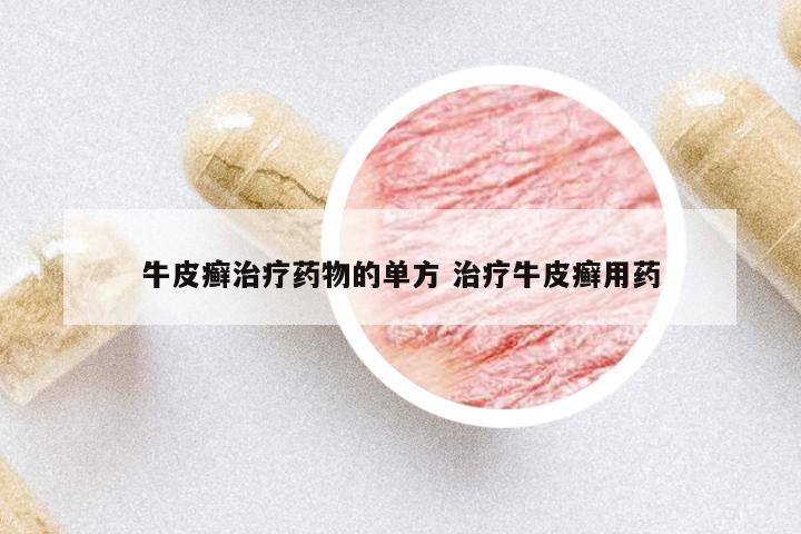 牛皮癬治療藥物的單方 治療牛皮癬用藥