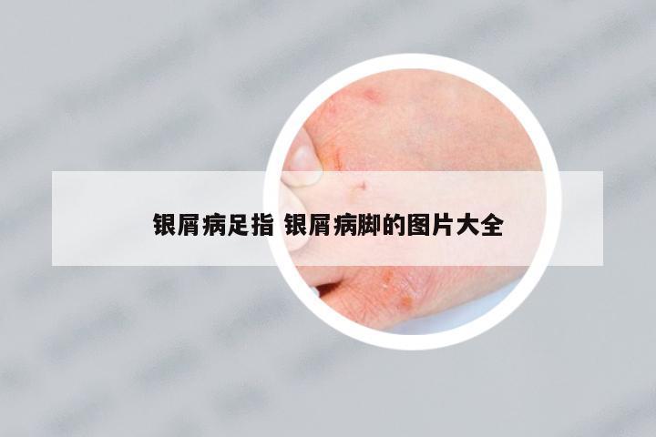 銀屑病足指 銀屑病腳的圖片大全