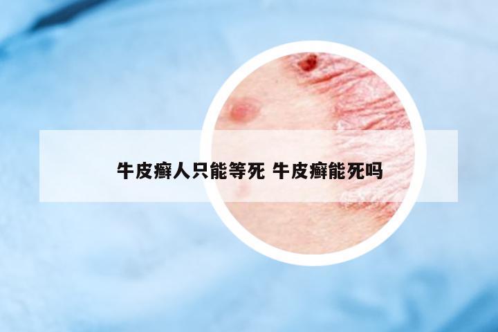牛皮癬人只能等死 牛皮癬能死嗎