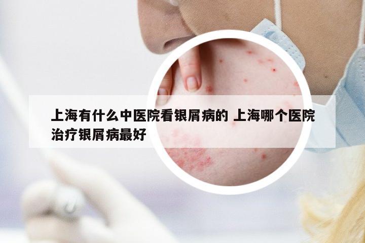 上海有什么中醫(yī)院看銀屑病的 上海哪個醫(yī)院治療銀屑病最好