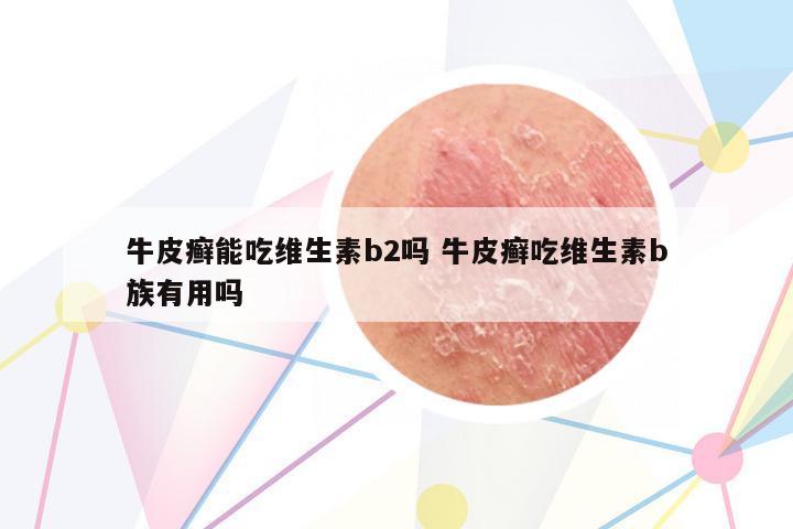 牛皮癬能吃維生素b2嗎 牛皮癬吃維生素b族有用嗎