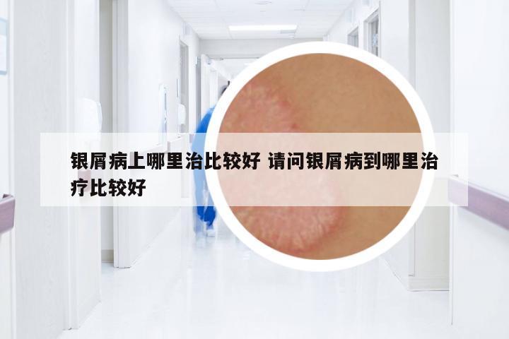 銀屑病上哪里治比較好 請問銀屑病到哪里治療比較好