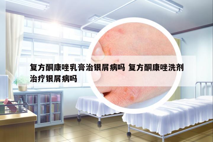 復(fù)方酮康唑乳膏治銀屑病嗎 復(fù)方酮康唑洗劑治療銀屑病嗎