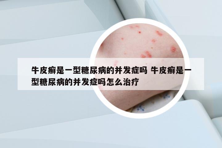 牛皮癬是一型糖尿病的并發(fā)癥嗎 牛皮癬是一型糖尿病的并發(fā)癥嗎怎么治療
