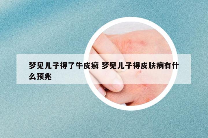 夢見兒子得了牛皮癬 夢見兒子得皮膚病有什么預(yù)兆