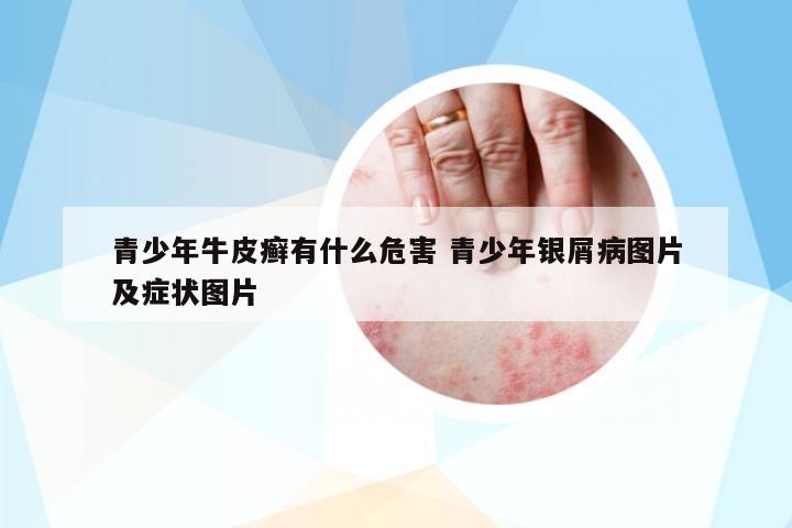 青少年牛皮癬有什么危害 青少年銀屑病圖片及癥狀圖片