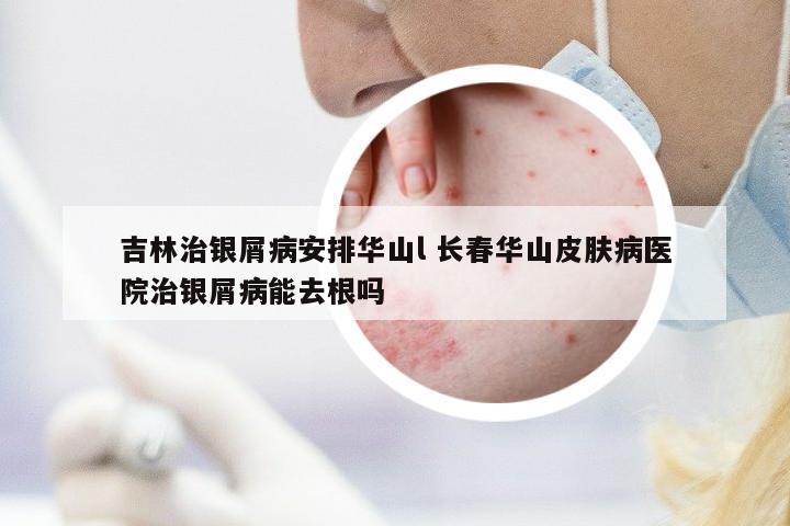 吉林治銀屑病安排華山l 長春華山皮膚病醫(yī)院治銀屑病能去根嗎