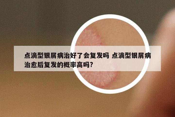 點(diǎn)滴型銀屑病治好了會(huì)復(fù)發(fā)嗎 點(diǎn)滴型銀屑病治愈后復(fù)發(fā)的概率高嗎?