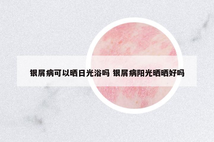 銀屑病可以曬日光浴嗎 銀屑病陽光曬曬好嗎