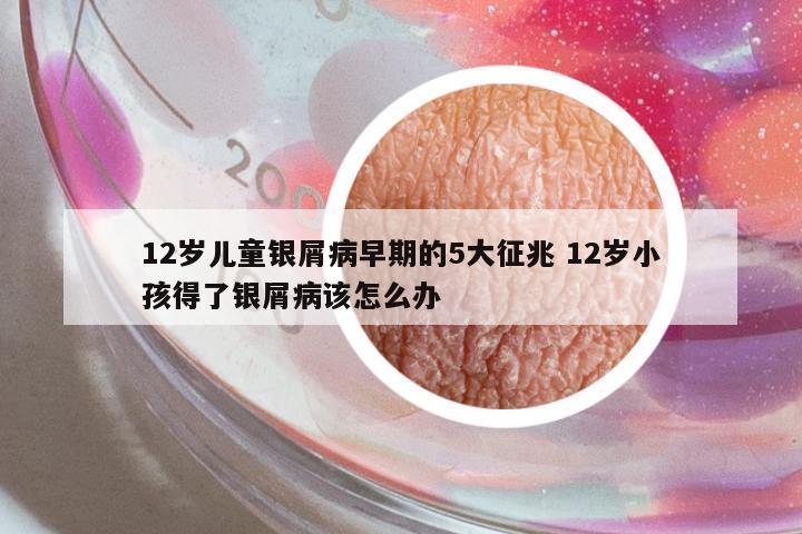 12歲兒童銀屑病早期的5大征兆 12歲小孩得了銀屑病該怎么辦