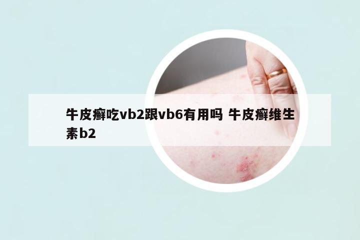 牛皮癬吃vb2跟vb6有用嗎 牛皮癬維生素b2