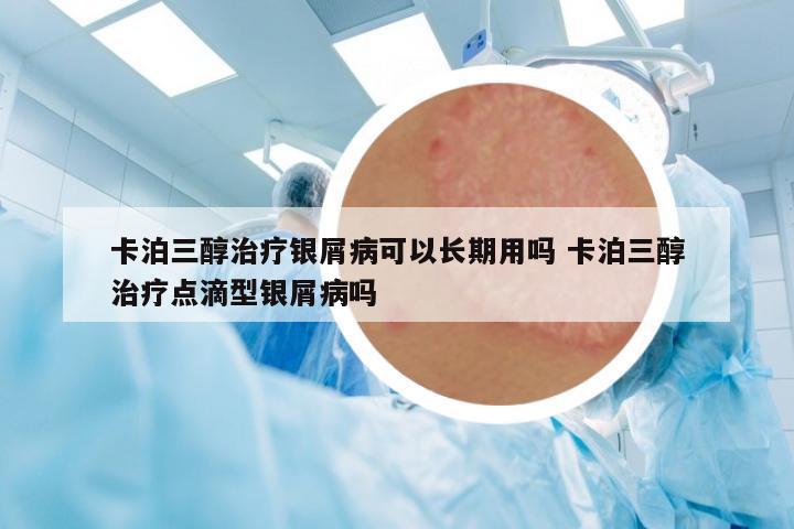 卡泊三醇治療銀屑病可以長(zhǎng)期用嗎 卡泊三醇治療點(diǎn)滴型銀屑病嗎