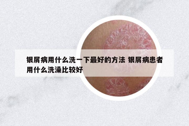 銀屑病用什么洗一下最好的方法 銀屑病患者用什么洗澡比較好