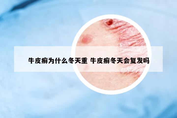 牛皮癬為什么冬天重 牛皮癬冬天會(huì)復(fù)發(fā)嗎