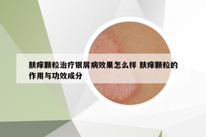 膚癢顆粒治療銀屑病效果怎么樣 膚癢顆粒的作用與功效成分