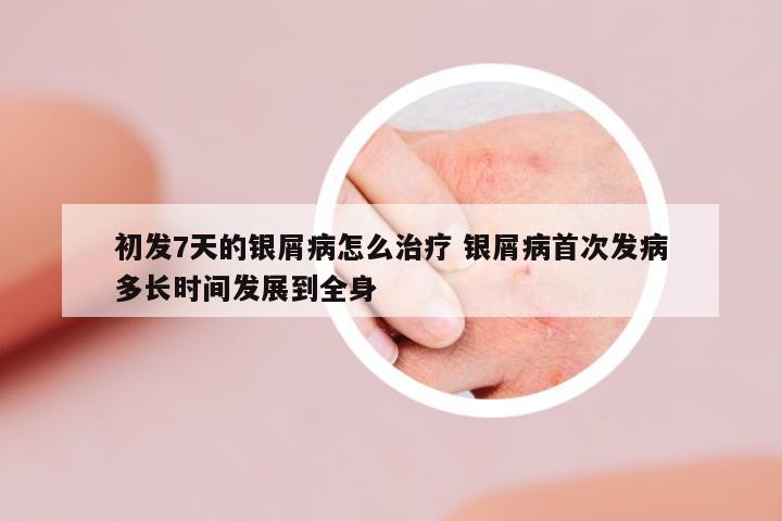 初發(fā)7天的銀屑病怎么治療 銀屑病首次發(fā)病多長(zhǎng)時(shí)間發(fā)展到全身