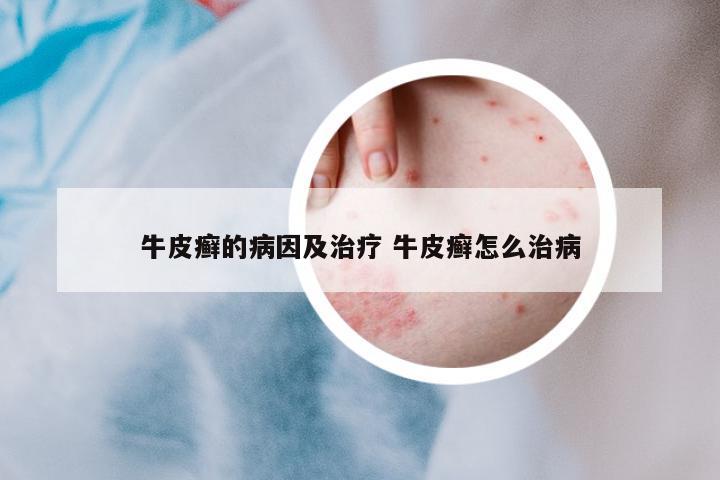 牛皮癬的病因及治療 牛皮癬怎么治病