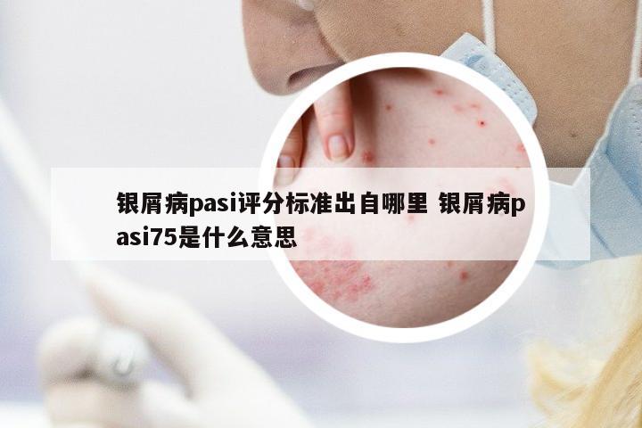 銀屑病pasi評(píng)分標(biāo)準(zhǔn)出自哪里 銀屑病pasi75是什么意思