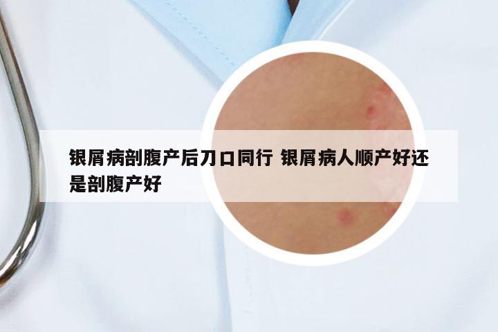 銀屑病剖腹產(chǎn)后刀口同行 銀屑病人順產(chǎn)好還是剖腹產(chǎn)好