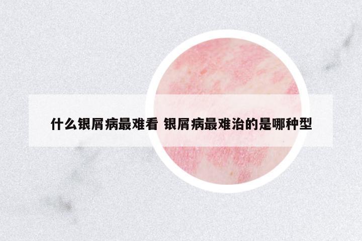 什么銀屑病最難看 銀屑病最難治的是哪種型