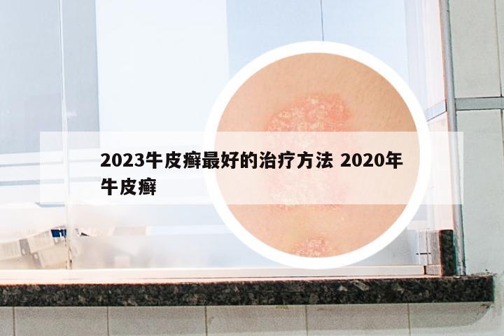 2023牛皮癬最好的治療方法 2020年牛皮癬