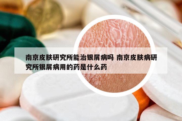 南京皮膚研究所能治銀屑病嗎 南京皮膚病研究所銀屑病用的藥是什么藥