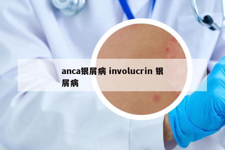 anca銀屑病 involucrin 銀屑病