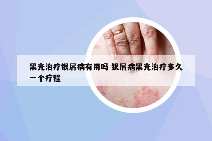 黑光治療銀屑病有用嗎 銀屑病黑光治療多久一個(gè)療程