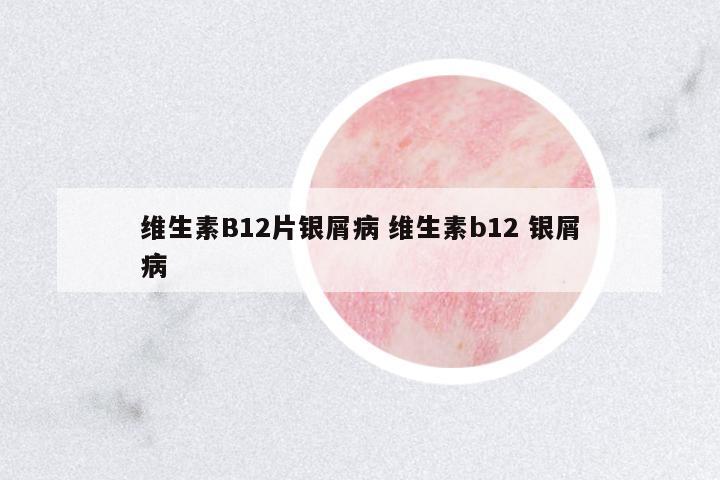 維生素B12片銀屑病 維生素b12 銀屑病