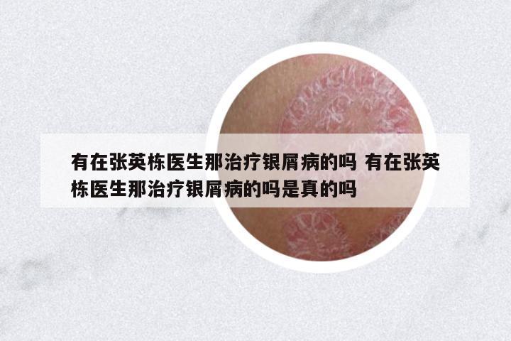 有在張英棟醫(yī)生那治療銀屑病的嗎 有在張英棟醫(yī)生那治療銀屑病的嗎是真的嗎