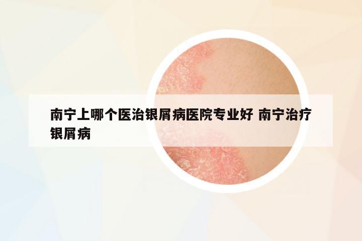 南寧上哪個醫(yī)治銀屑病醫(yī)院專業(yè)好 南寧治療銀屑病