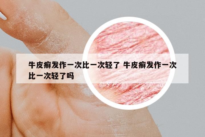 牛皮癬發(fā)作一次比一次輕了 牛皮癬發(fā)作一次比一次輕了嗎