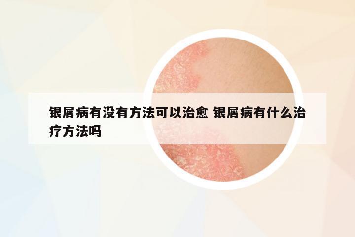 銀屑病有沒有方法可以治愈 銀屑病有什么治療方法嗎