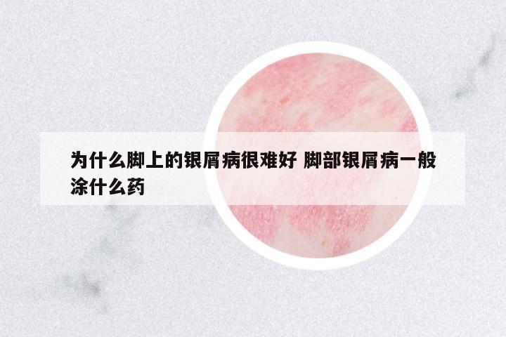 為什么腳上的銀屑病很難好 腳部銀屑病一般涂什么藥