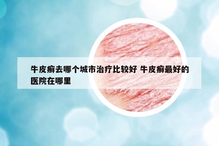 牛皮癬去哪個(gè)城市治療比較好 牛皮癬最好的醫(yī)院在哪里