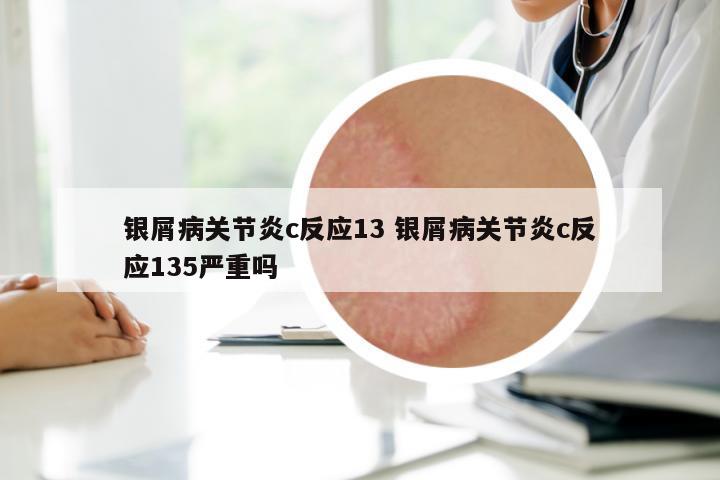 銀屑病關(guān)節(jié)炎c反應(yīng)13 銀屑病關(guān)節(jié)炎c反應(yīng)135嚴(yán)重嗎