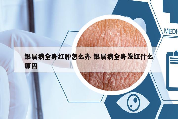 銀屑病全身紅腫怎么辦 銀屑病全身發(fā)紅什么原因