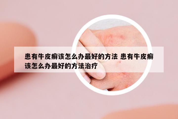 患有牛皮癬該怎么辦最好的方法 患有牛皮癬該怎么辦最好的方法治療