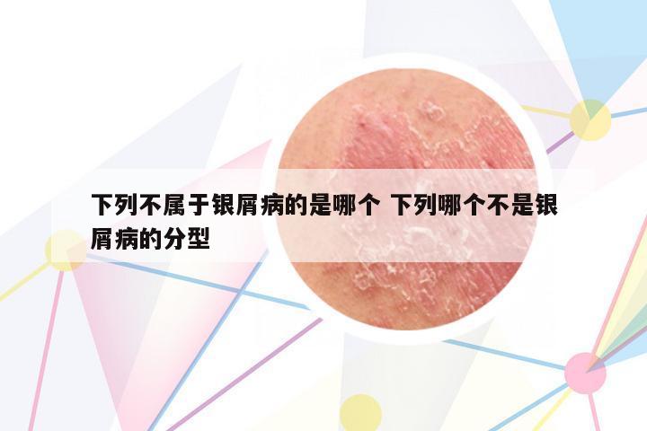 下列不屬于銀屑病的是哪個(gè) 下列哪個(gè)不是銀屑病的分型