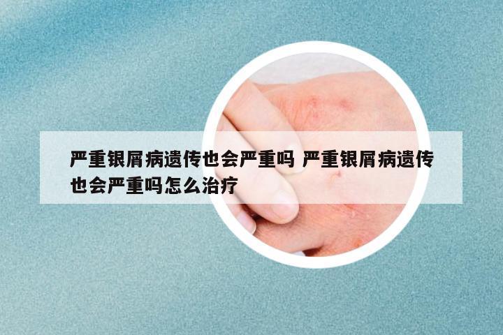 嚴(yán)重銀屑病遺傳也會嚴(yán)重嗎 嚴(yán)重銀屑病遺傳也會嚴(yán)重嗎怎么治療