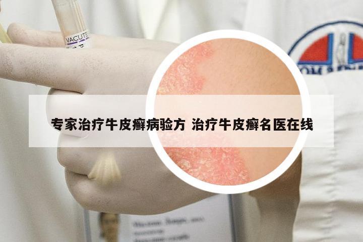 專家治療牛皮癬病驗(yàn)方 治療牛皮癬名醫(yī)在線