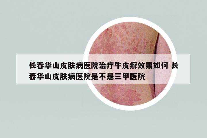 長春華山皮膚病醫(yī)院治療牛皮癬效果如何 長春華山皮膚病醫(yī)院是不是三甲醫(yī)院