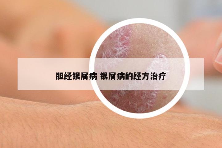 膽經(jīng)銀屑病 銀屑病的經(jīng)方治療