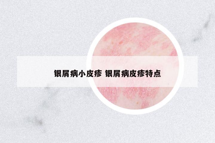 銀屑病小皮疹 銀屑病皮疹特點