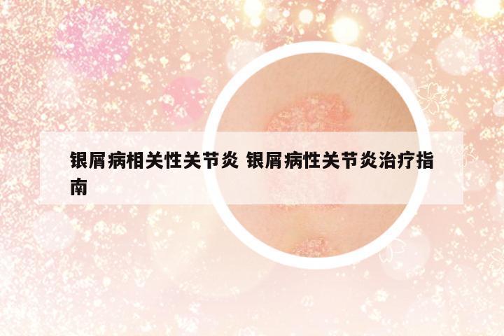 銀屑病相關(guān)性關(guān)節(jié)炎 銀屑病性關(guān)節(jié)炎治療指南